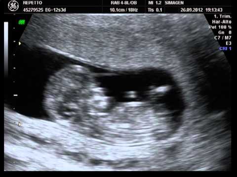 ECOGRAFIA TRASNUCAL 11 SEMANAS Y 6 DIAS - YouTube