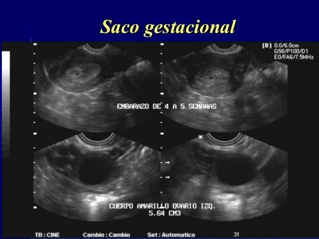 Ecografia del primer trimestre