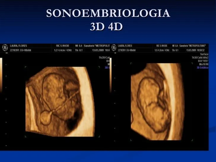 Ecografia del primer trimestre