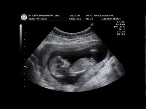 Ecografias de 13 semanas - Imagui