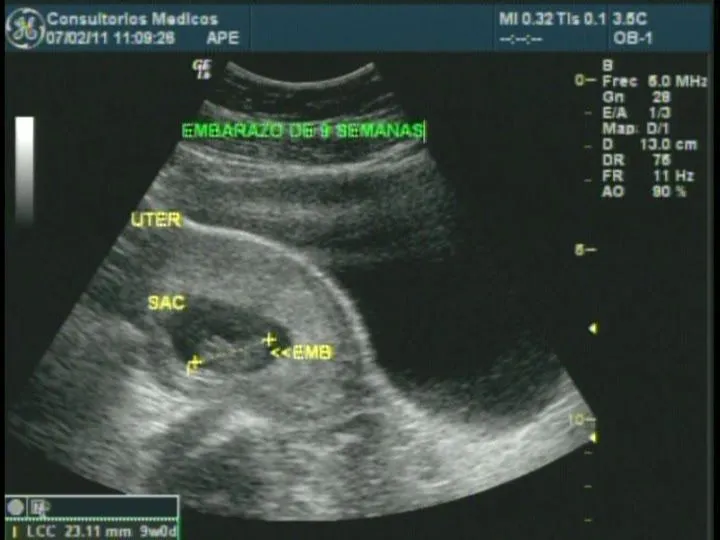 Ecografías de embarazo de 9 semanas - Imagui