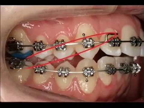 Uso de los elasticos en Ortodoncia Fija | Dental TV Web