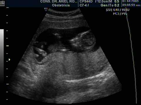 EMBARAZO DE 12 SEMANAS, DR ARIEL RODRIGUEZ, UNION MEDICA SANTIAGO ...