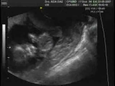 Embarazo 12 semanas - YouTube