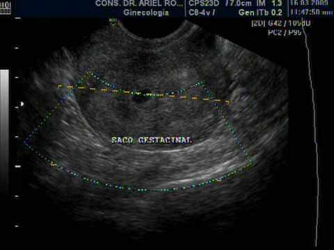 EMBARAZO DE 3 SEMANAS. DR. ARIEL RODRIGUEZ, UNION MEDICA, SANTIAGO ...