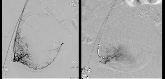 Embolizacion De Fibromas Uterinos - Imagui