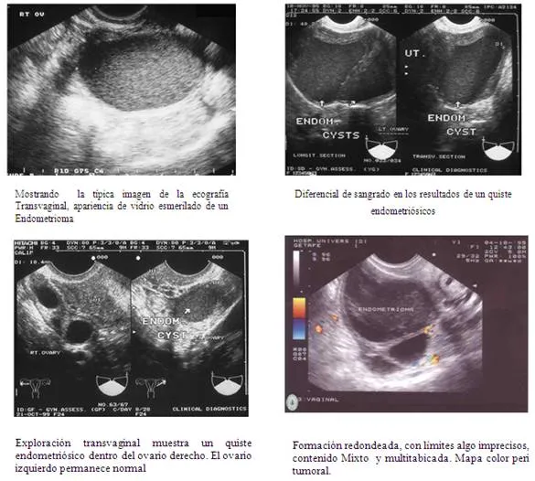 Endometriosis - endometrioma - Monografias.