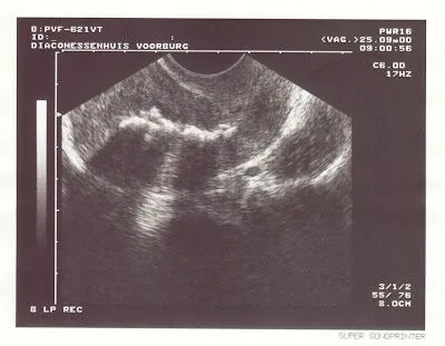 Endoscopia Ginecologica: agosto 2008