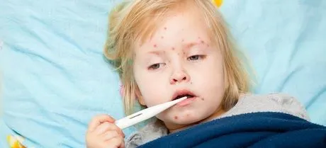 Enfermedades comunes del bebé: sarampión