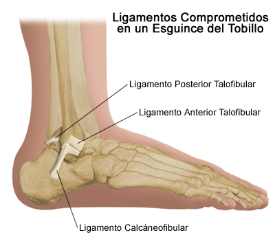 Esguince de Tobillo, una lesión muy común | Punto Fape