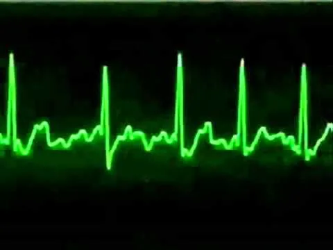 Fibrilacion | Triton TV