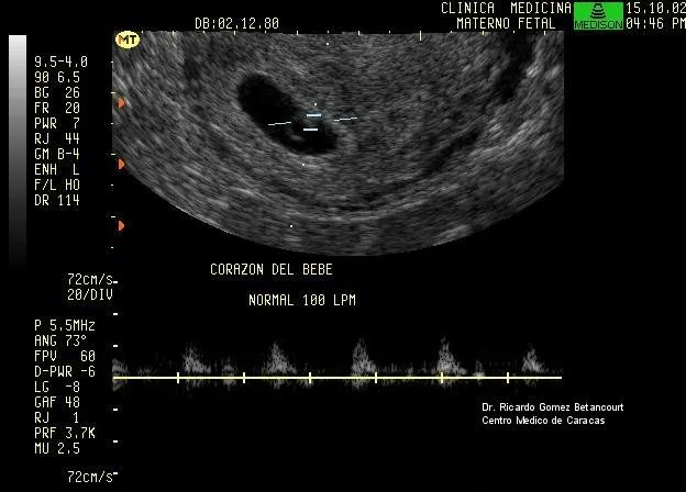 Ecografías de cinco semanas de embarazo - Imagui