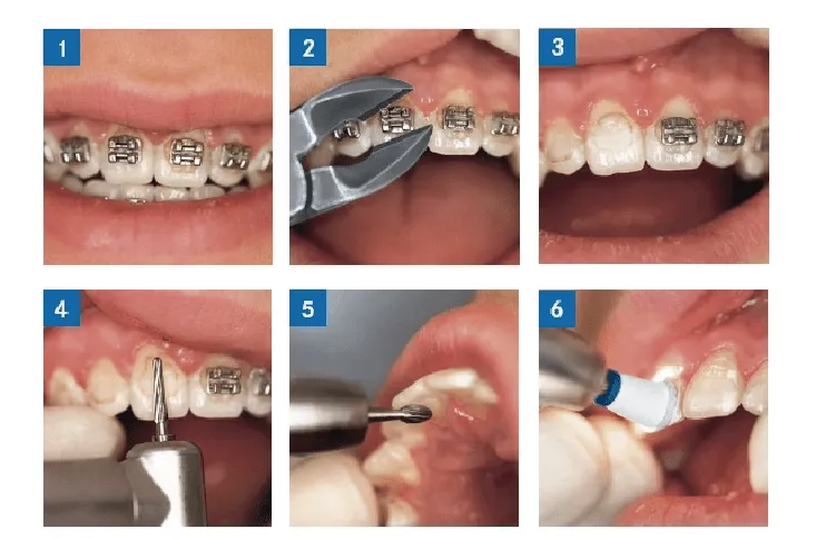 Fresa “AGK” para remover adhesivo de brackets | Bienvenido al Blog ...