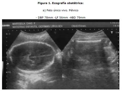 Gaceta Médica Boliviana - SÍNDROME DE BRIDAS AMNIOTICAS