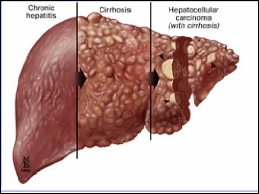 HEPATITES, CIRROSE E HEPATOCARCINOMA. | lamoreabio: biologia geral ...