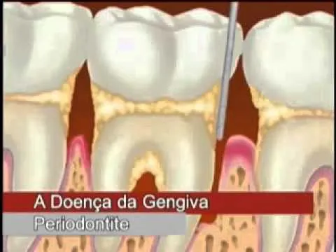 Higiene Bucal - Placa Bacteriana | Cárie | Tártaro - YouTube