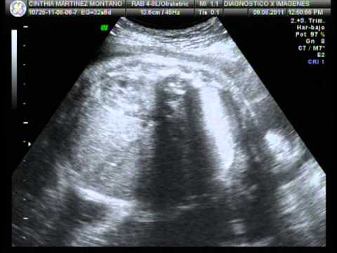 ULTRASONIDO 4D NIÑA - YouTube