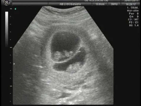 Imagenes de ecografias gemelos - Imagui