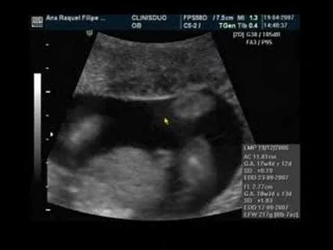 Ecografia 17 semanas niña - Imagui