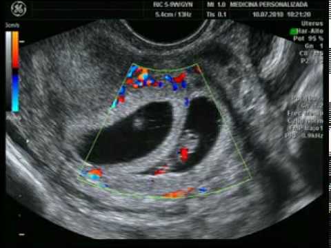 Ecografía 5 semanas mellizos - Imagui
