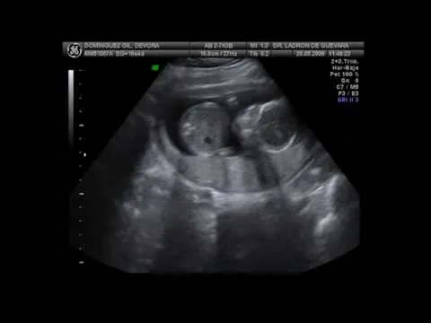 Ecografia de niña 14 semanas - Imagui