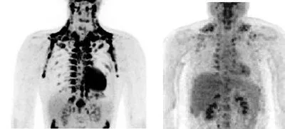 Imágenes de PET-TAC de grasa parda - ELPAÍS.com