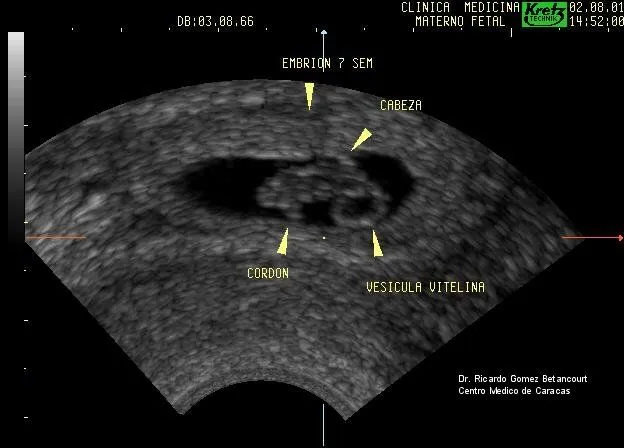 Ecografia 7 semanas de gestacion - Imagui