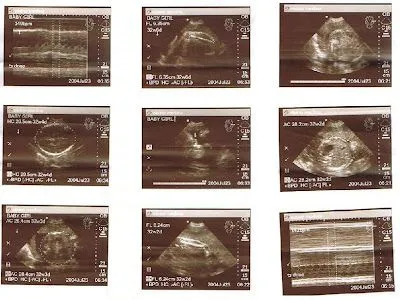 Ultrasonido de 4 meses - Imagui