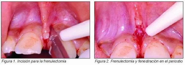 Influencia de los frenillos labiales en el tratamiento ortodóncico ...