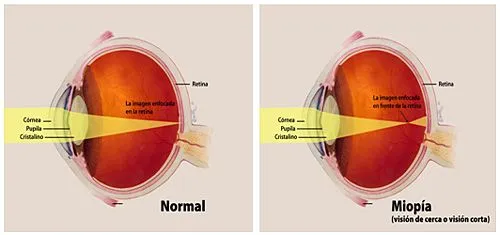 Información Sobre La Miopía | National Eye Institute