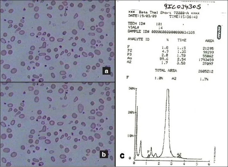 Information, Hemoglobin Barts Symptoms