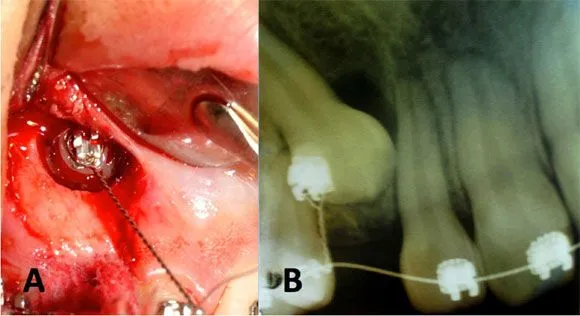 International journal of odontostomatology - Abordaje Quirúrgico ...