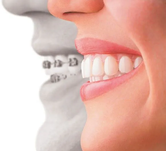 Invisalign: La alternativa transparente a los brackets | sonrisas ...