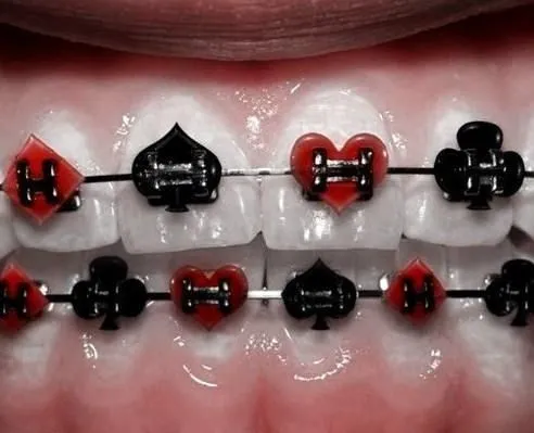 Love your braces get creative! diamonds, hearts, and clovers ...