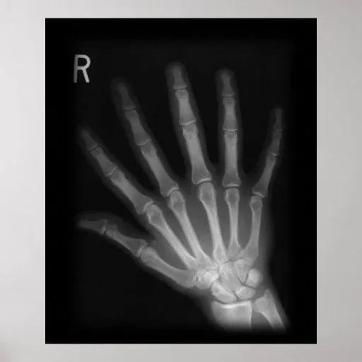 Mano derecha adicional de la radiografía del dígit posters | Zazzle