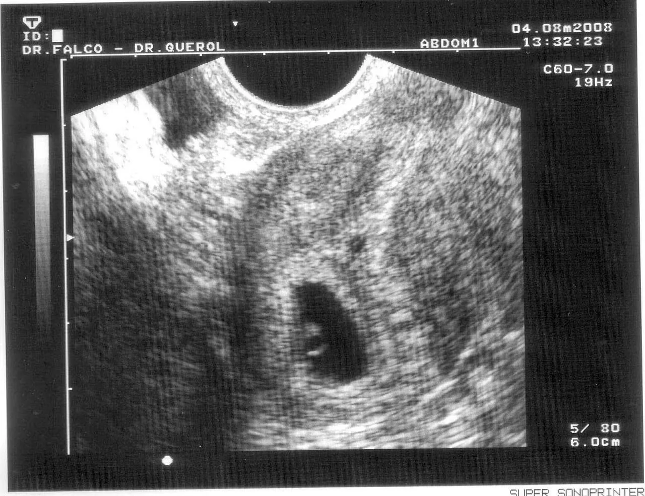 MATERNIDAD Y PSICOLOGÍA ☼: ECOGRAFIAS POR SEMANAS. Imágenes