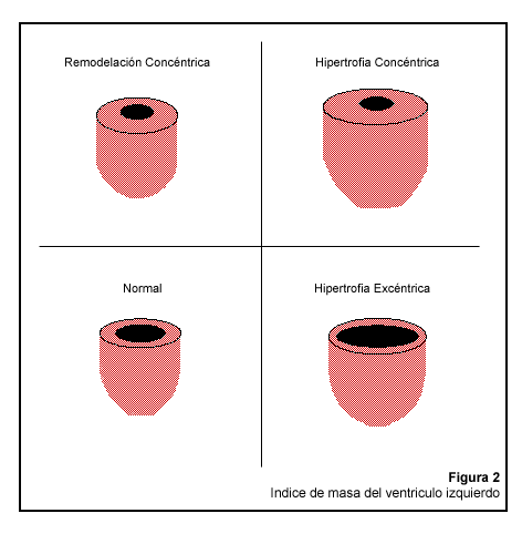 Miocardiopatía hipertensiva versus miocardiopatía hipertrófica ...