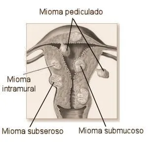 Miomas uterinos