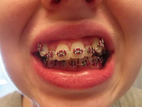 My Journey With Braces