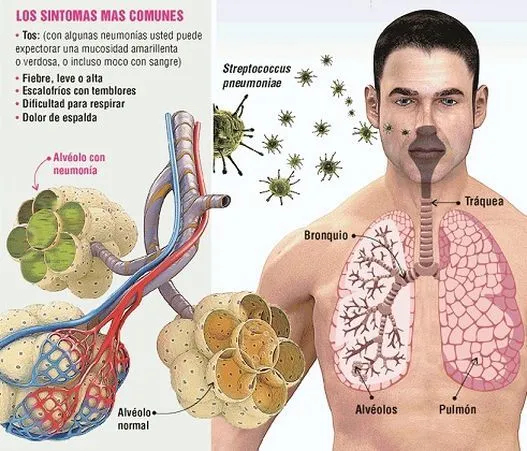 Neumococos y Vacunación | El Blog de Fatouh