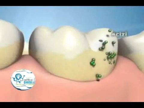 PLACA BACTERIANA - CHDN - YouTube