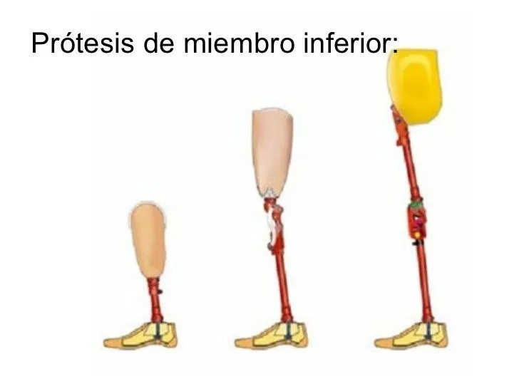 Prótesis y rehabilitación de amputados