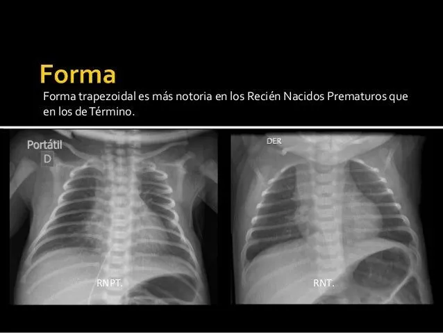 radiografia-de-torax-patologia ...