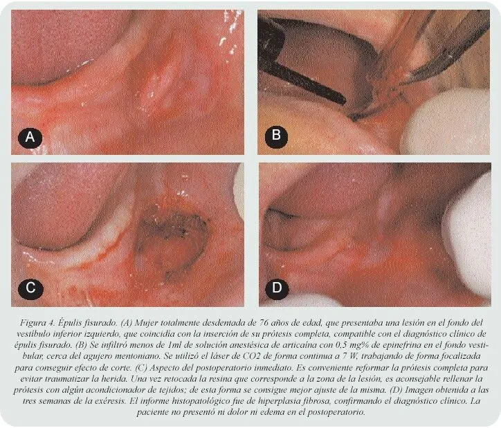 RCOE - Aplicaciones del láser en Odontología