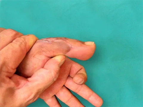 Reconstrucción del pulgar. Dr. Óscar Villafañe: Cirugía Plástica ...