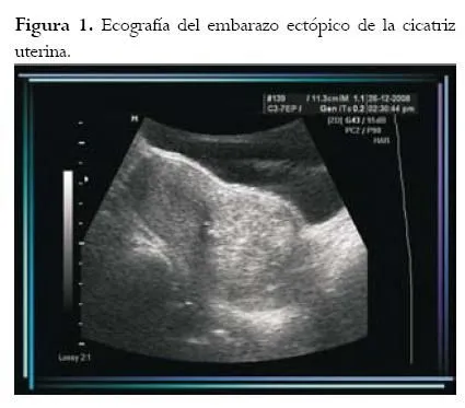 Revista Colombiana de Obstetricia y Ginecología - Ectopic ...