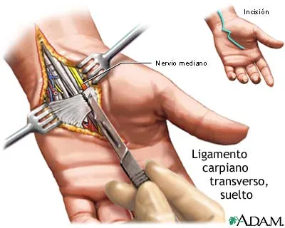 SALUD OCUPACIONAL: SÍNDROME DEL TÚNEL CARPIANO