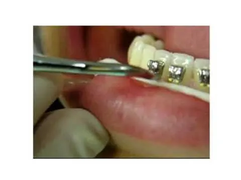 Self Ligating Bracket - Carriere® LX - YouTube