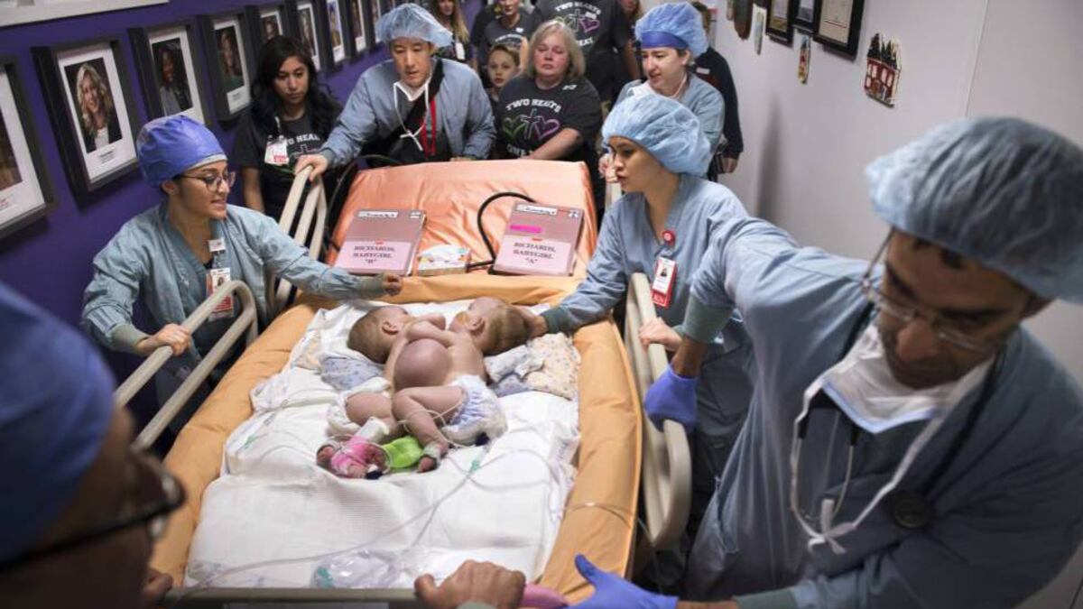 Separadas con éxito dos gemelas que nacieron unidas por el pecho en EE UU | M&P