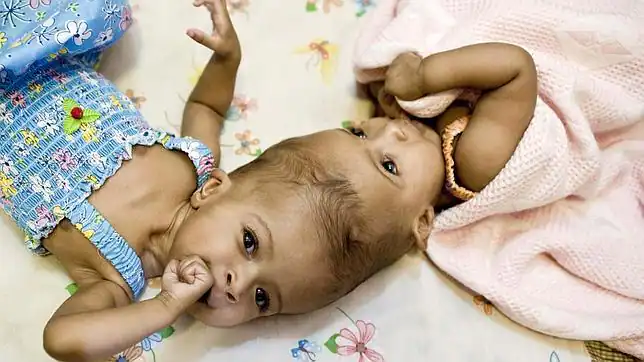 Separados con éxito dos bebés sudaneses unidos por la cabeza en ...